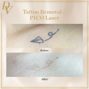 Tattoo Removal using Pico Laser