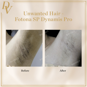 Hair Removal Treatment Before and After