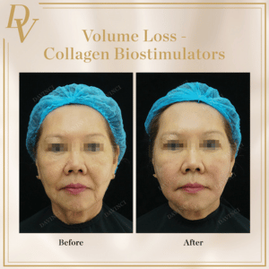Collagen Biostimulator Before and After