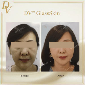 DV™ GlassSkin Before and After Photos