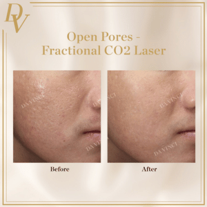 Open Pores Treatment Fractional CO2 Before and After
