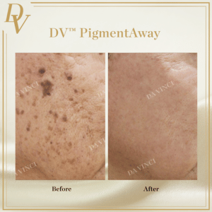Pigmentation Removal Before and After Photos in KL
