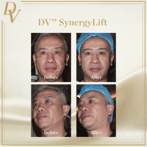 DV Synergy Lift I Da Vinci Clinic
