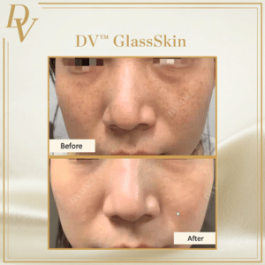 DV™ GlassSkin