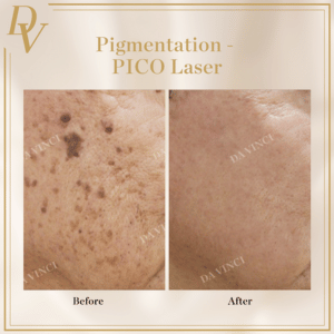 Pico Laser Pigmentation Removal Before and After