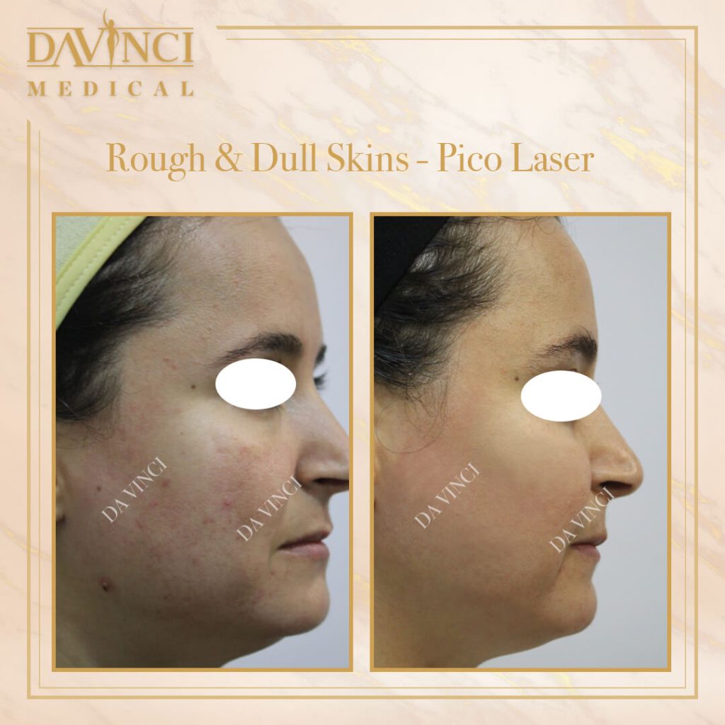 Pico Laser Before and After in KL By Da Vinci Clinic