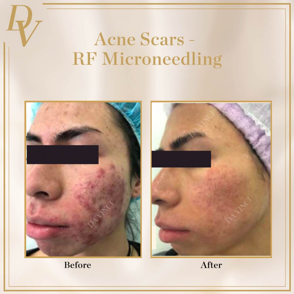 Acne Scars I RF Microneedling
