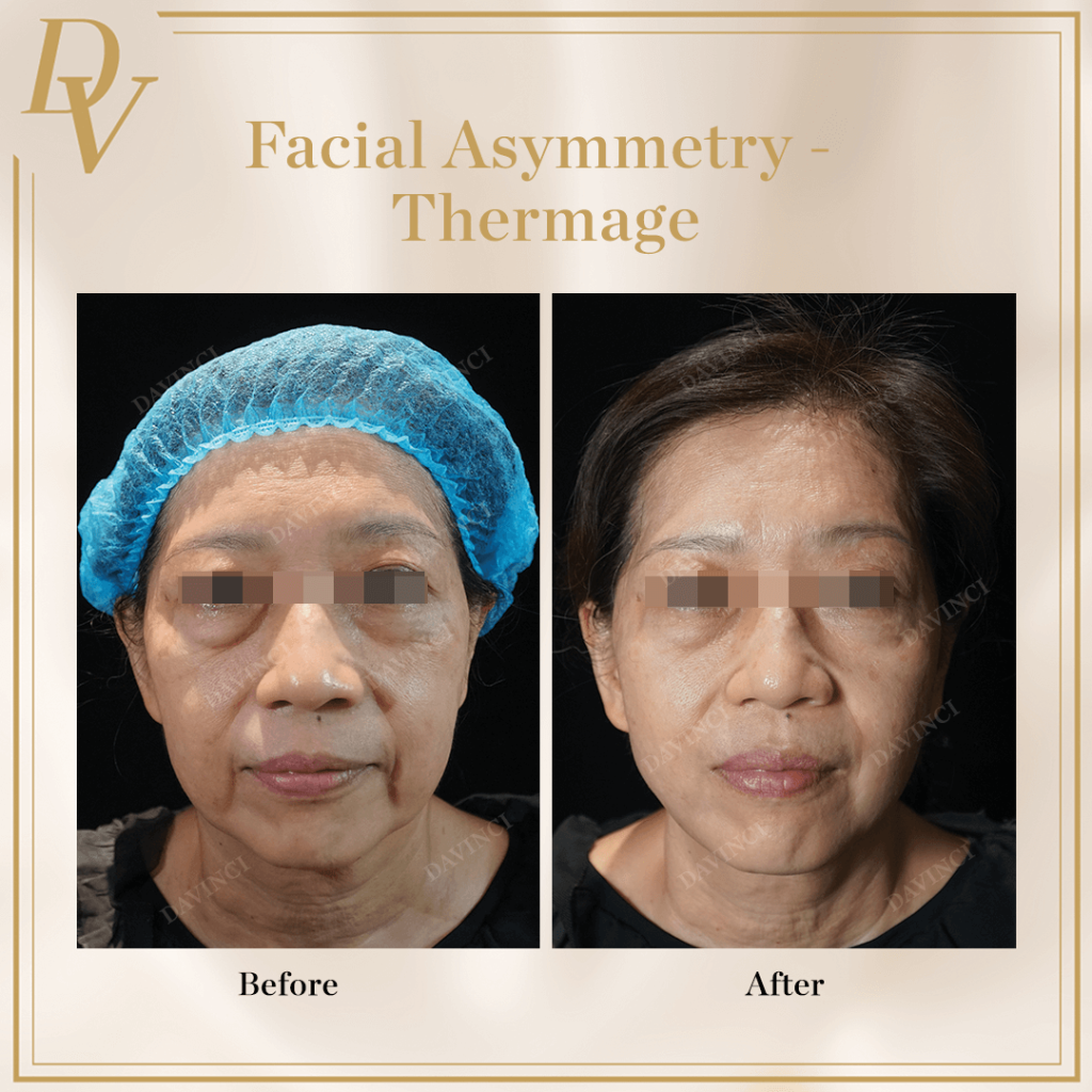 Facial Asymmetry Thermage Before and After