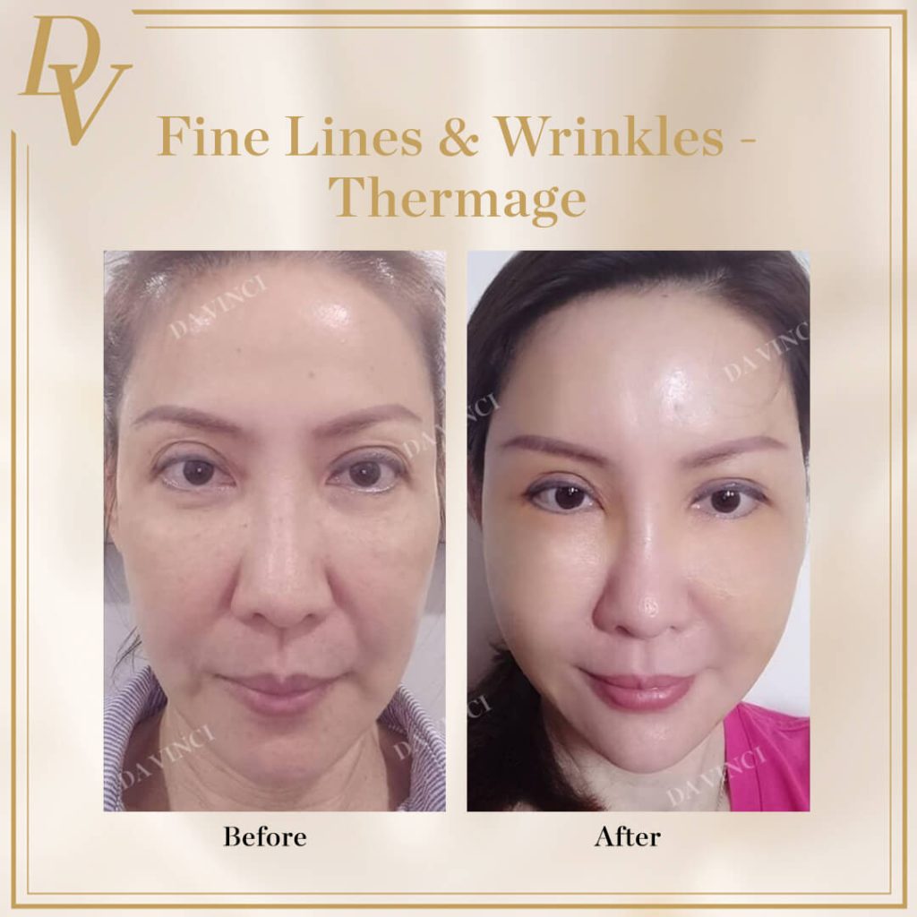 Fine Lines & Wrinkles Before & After