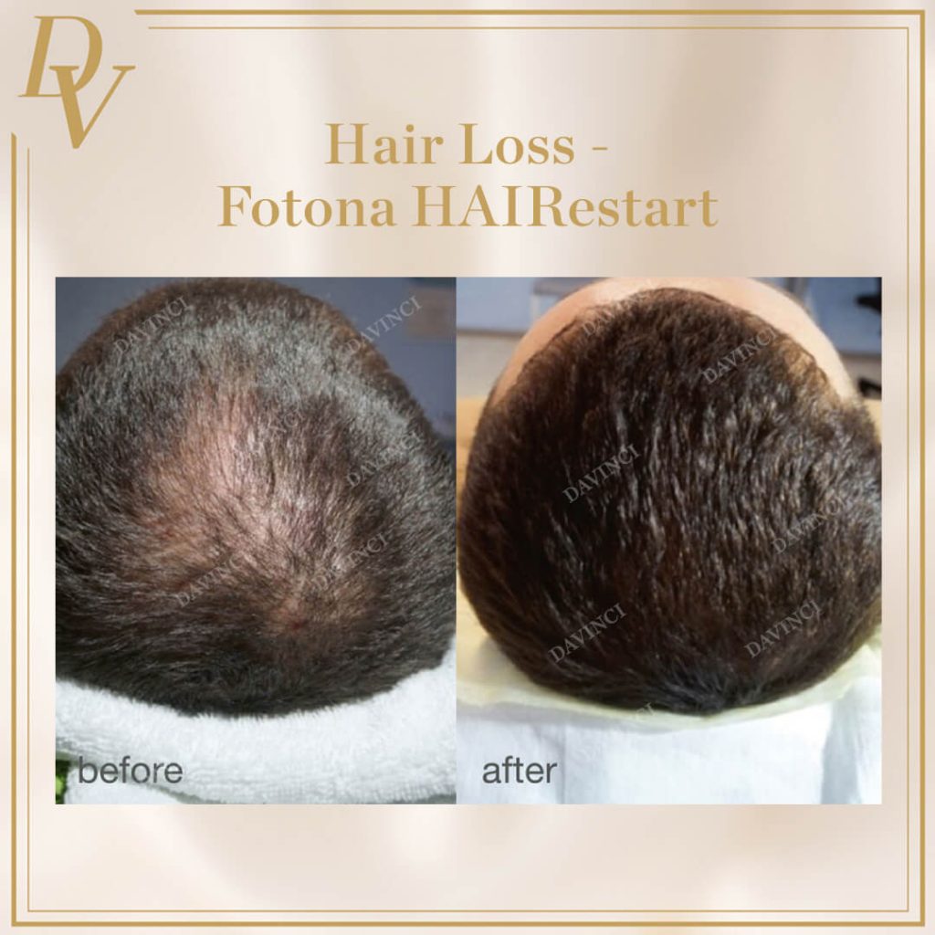 Hair Loss Treatment Before and After I Da Vinci Clinic