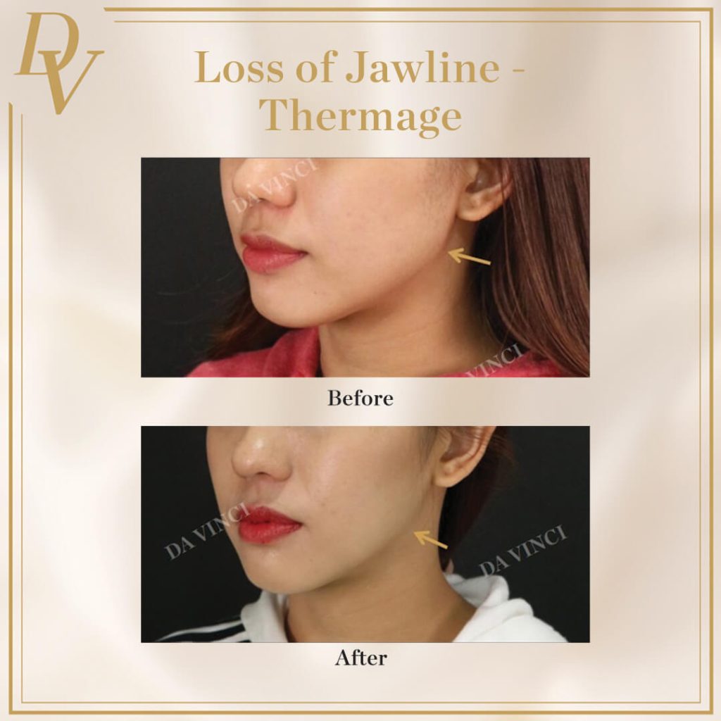 Loss of Jawline