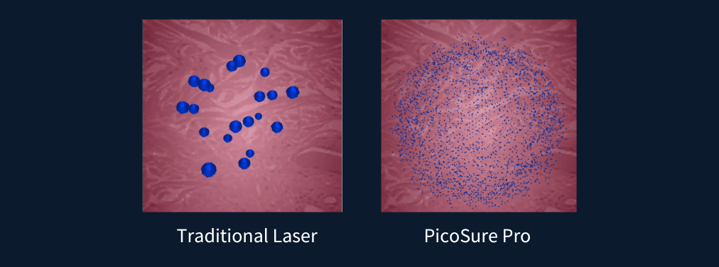 Pico Laser Treatment in KL