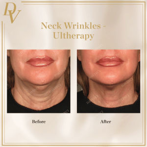 Ultherapy Neck Wrinkles
