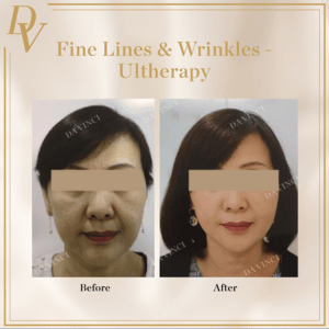 Fine Lines & Wrinkles Removal