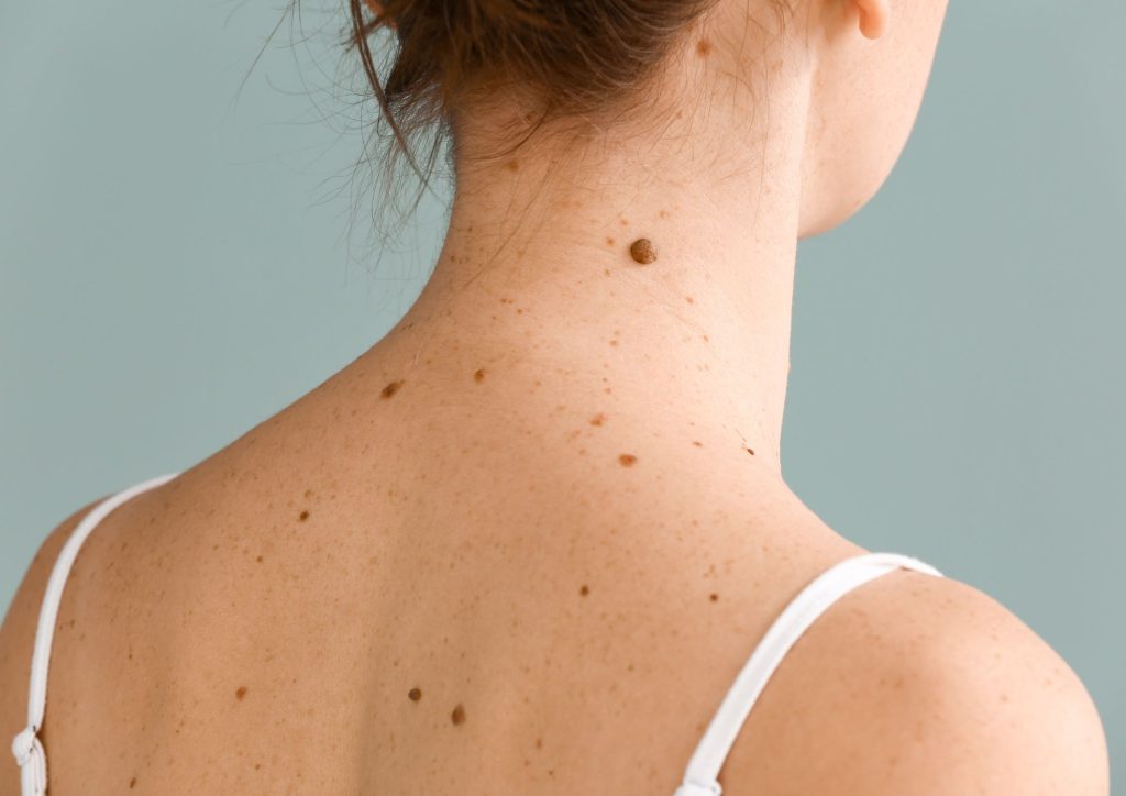 Skin tags, Skin mole