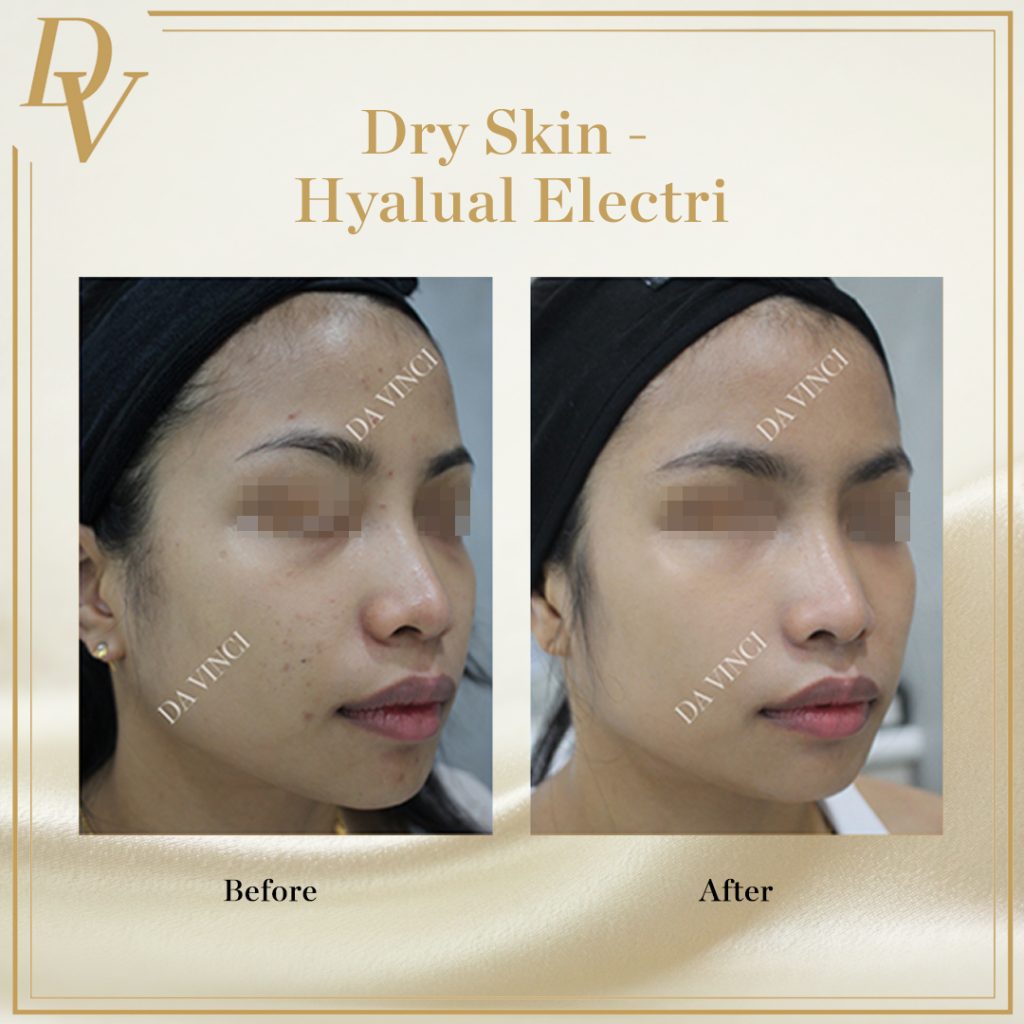 Hyalula Electri, Dry Skin
