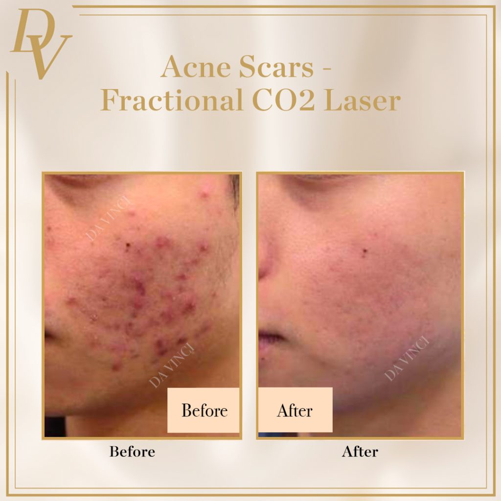 Fractional CO2 laser acne scars