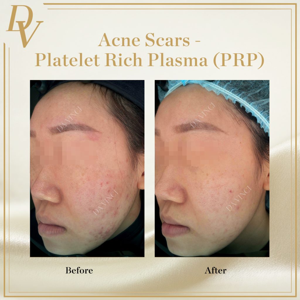 Acne Scars, Platelet Rich Plasma PRP