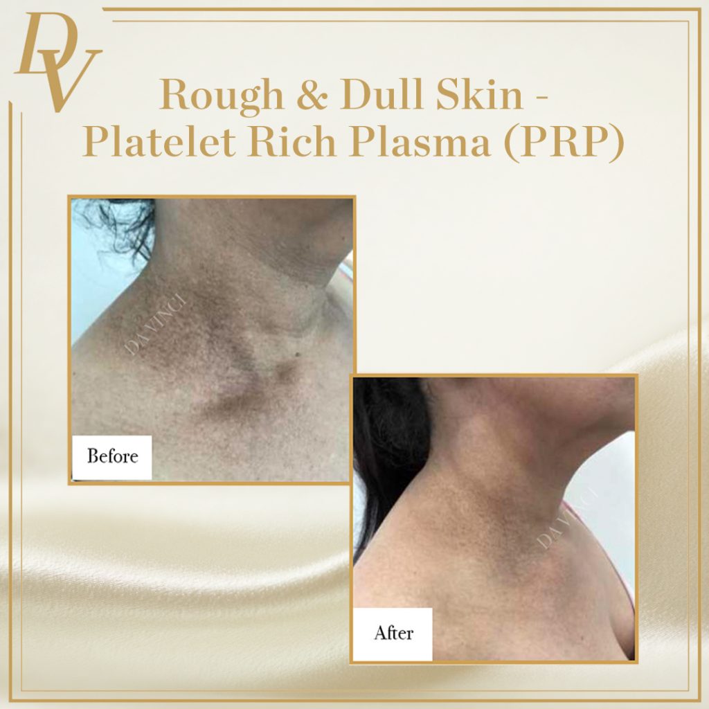 Dry Skin, Platelet Rich Plasma PRP