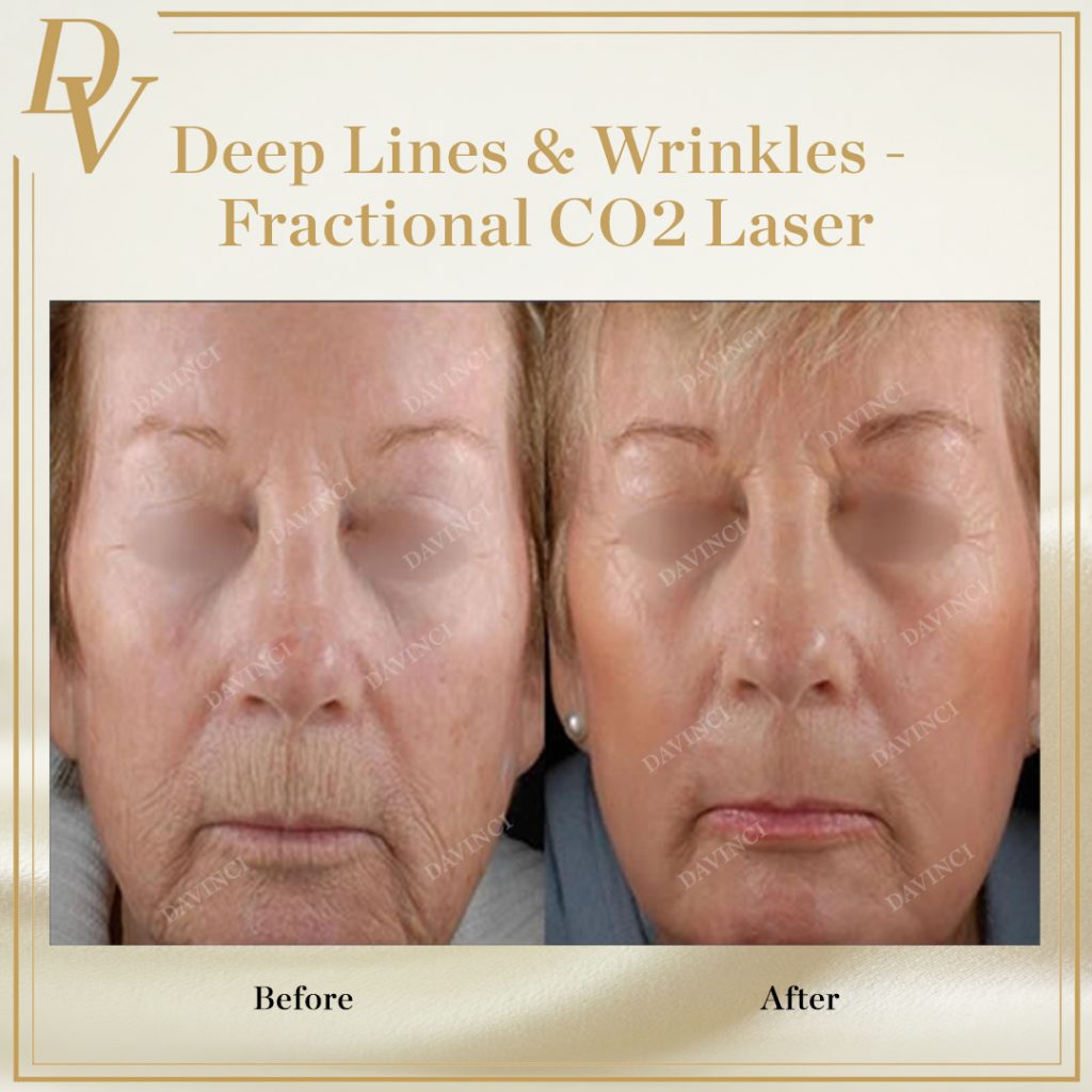 Fractional CO2 laser deep lines wrinkles