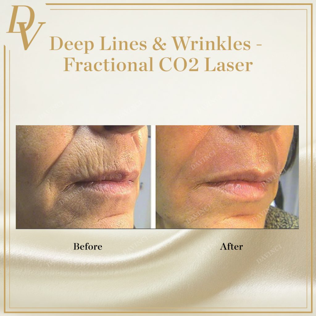 Fractional CO2 laser deep lines wrinkles