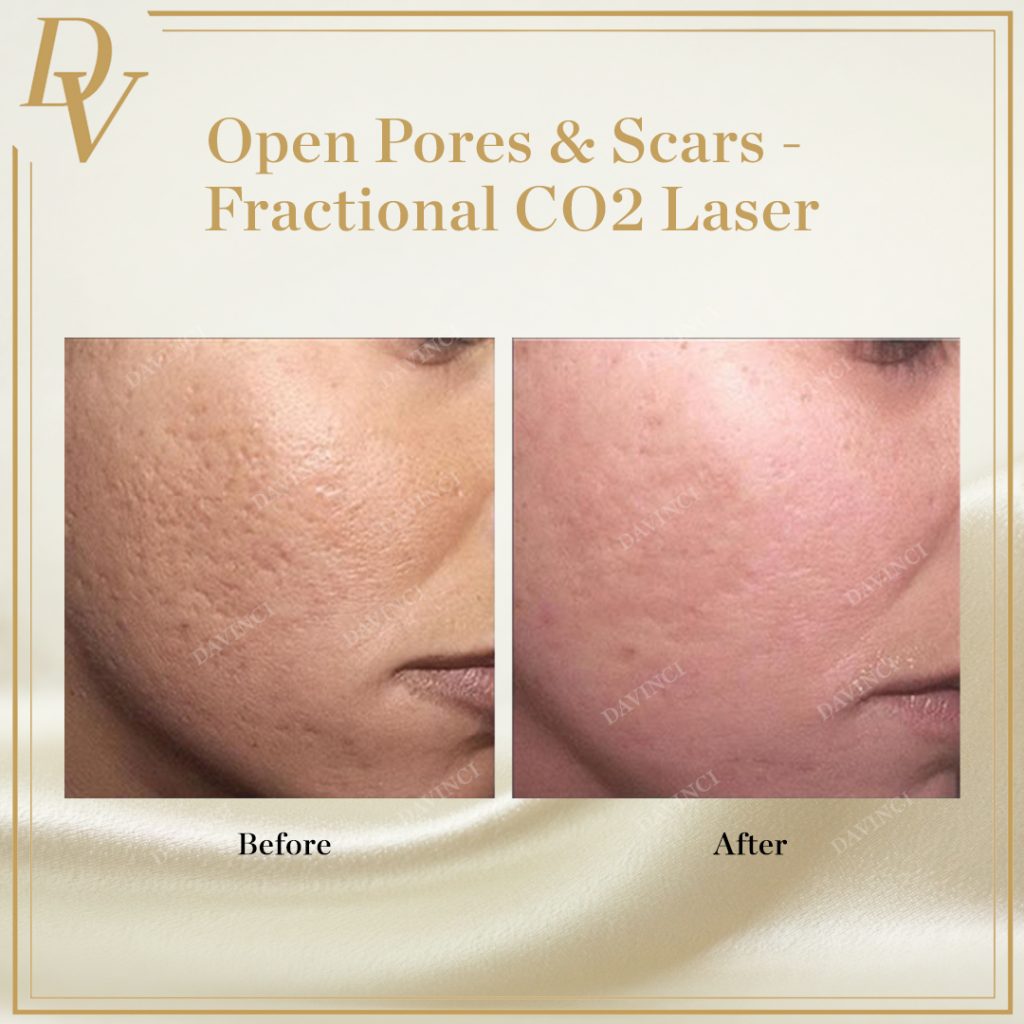 Fractional CO2 laser Open pores & scars