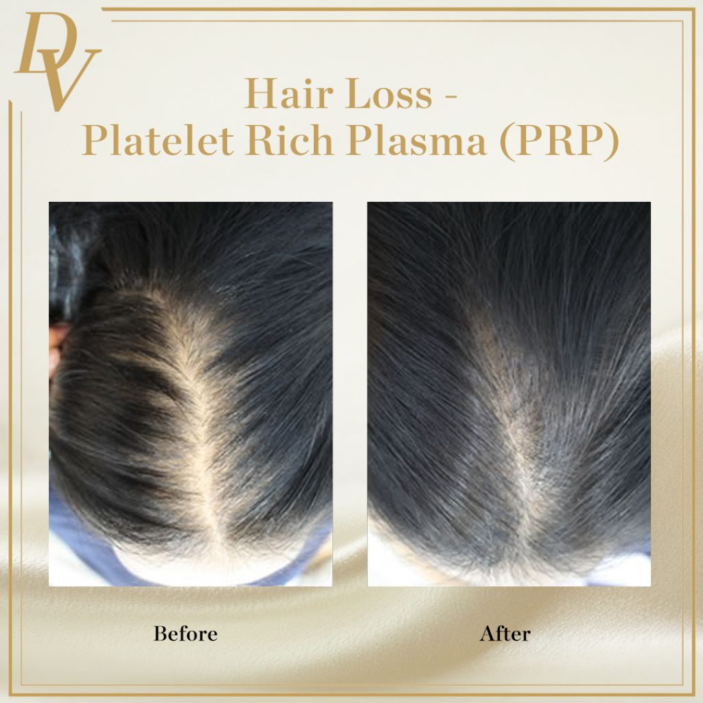 Hair Loss, Platelet Rich Plasma, PRP