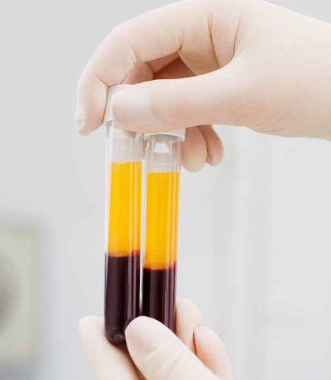 What is PRP treatment