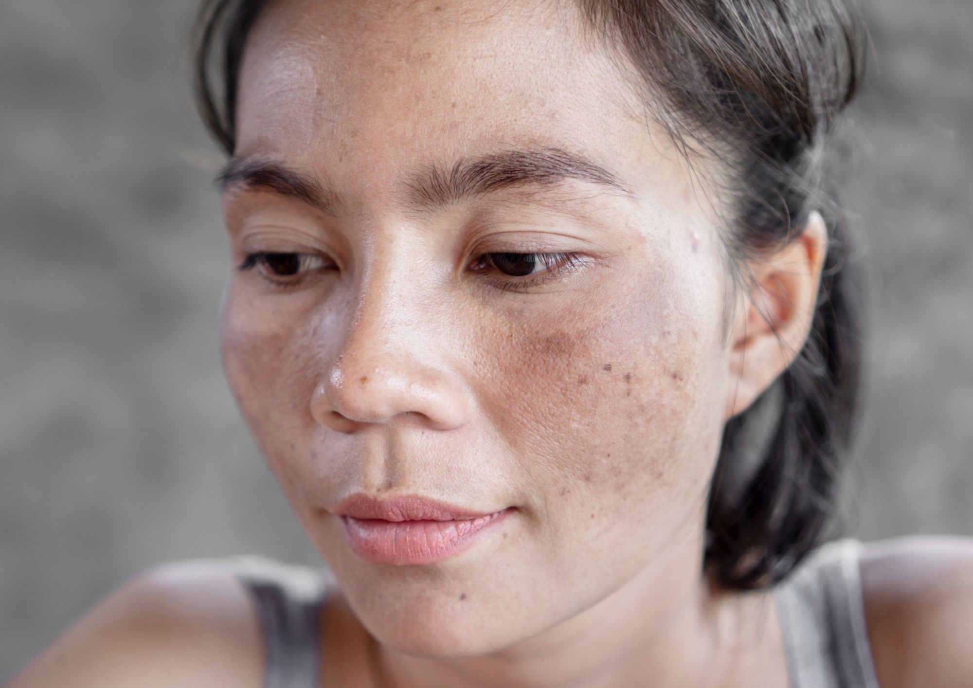 melasma-skin-pigmentation-da-vinci-clinic