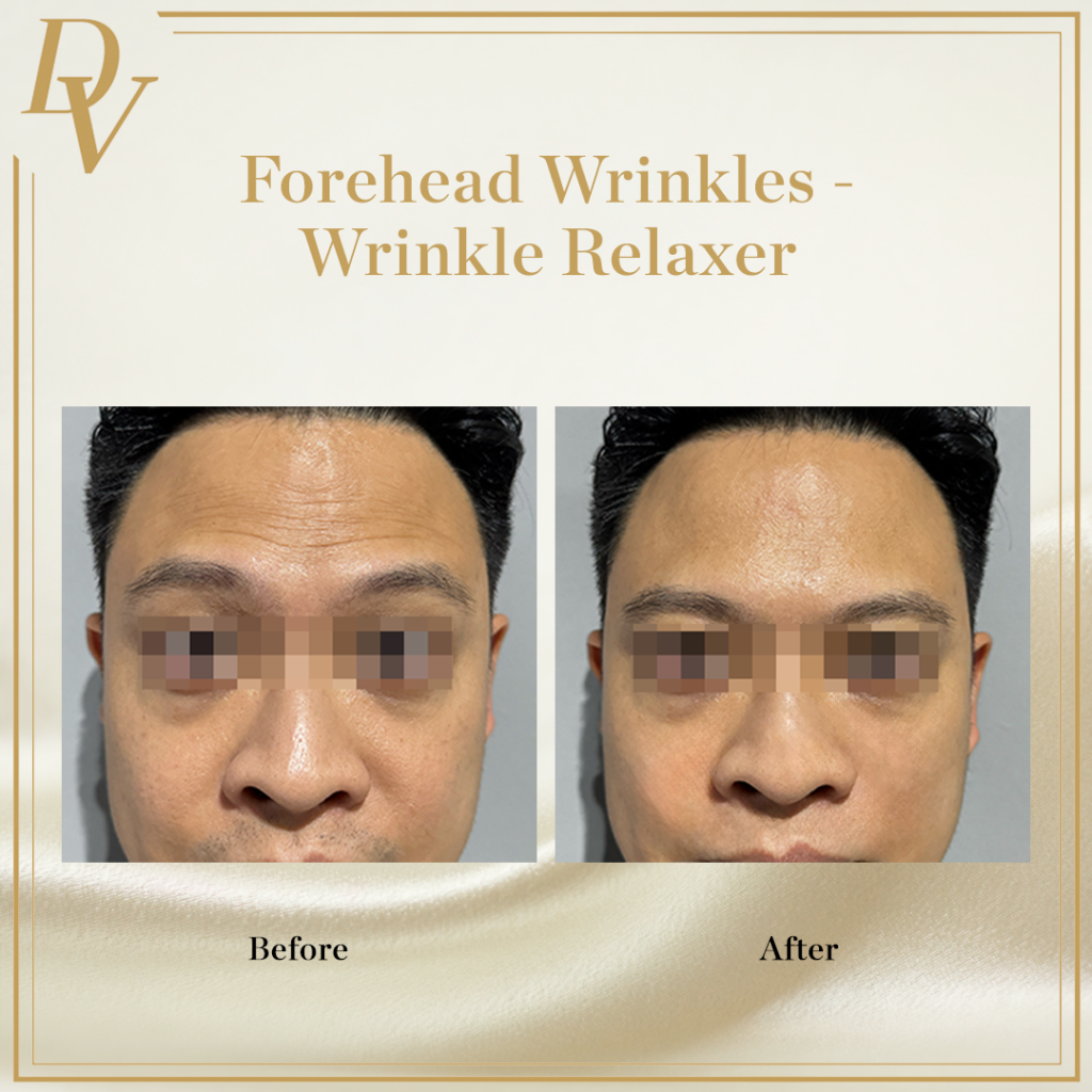 Forehead wrinkles, Wrinkle relaxer, botox, xeomin, nabota