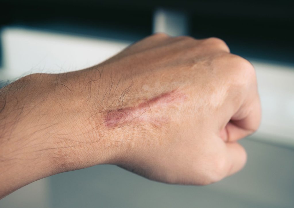 Keloid scar treatment, Da Vinci Clinic