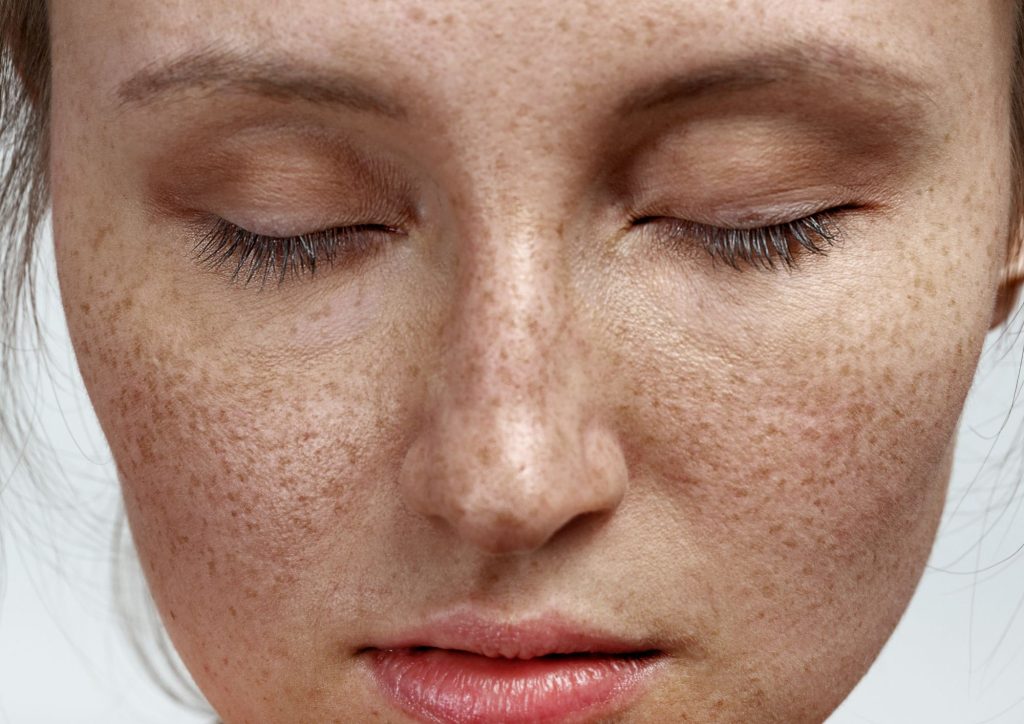 Freckles Treatment Da Vinci Clinic