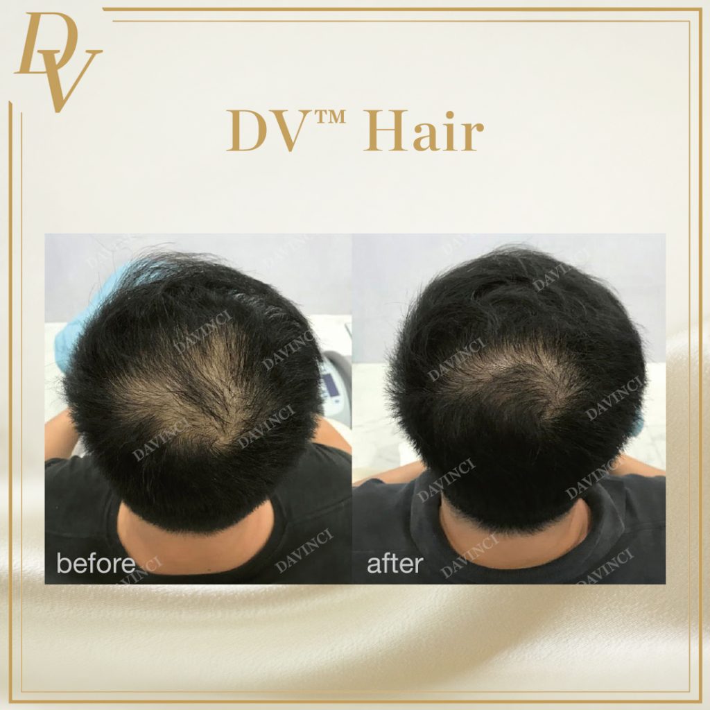 Da Vinci Clinic Hair Treatment in KL