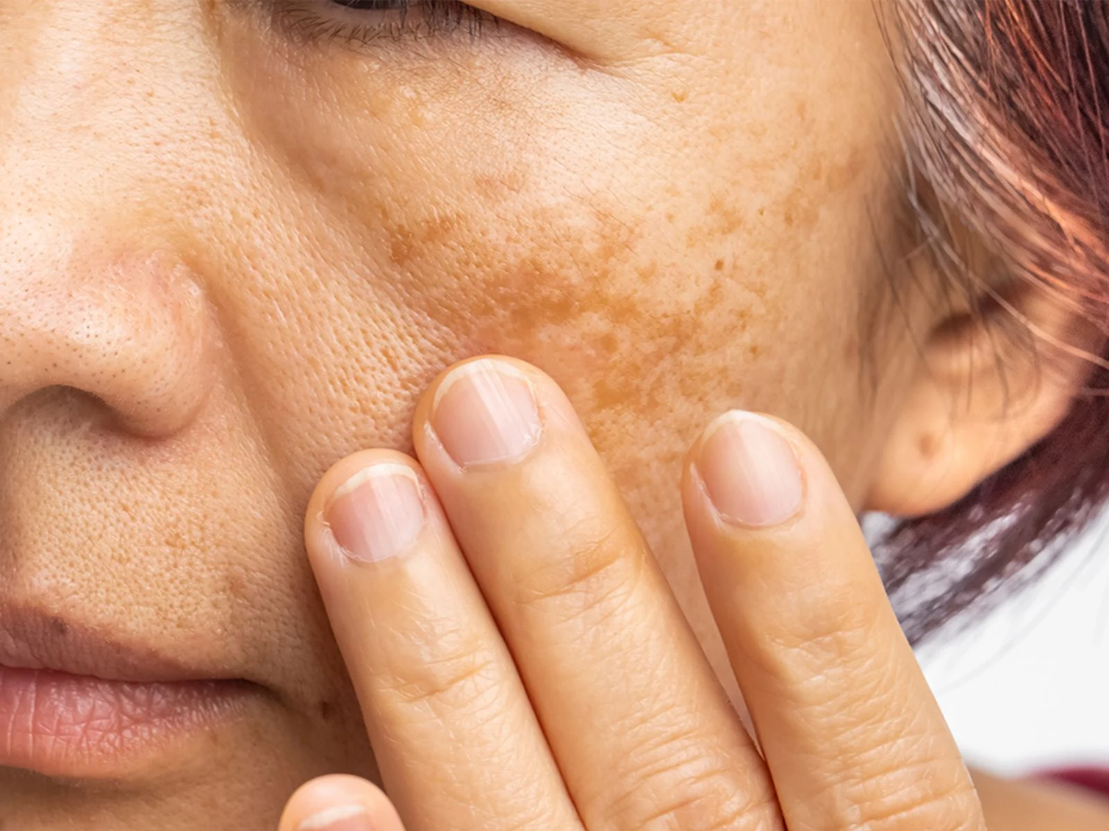 Asian pigmentation