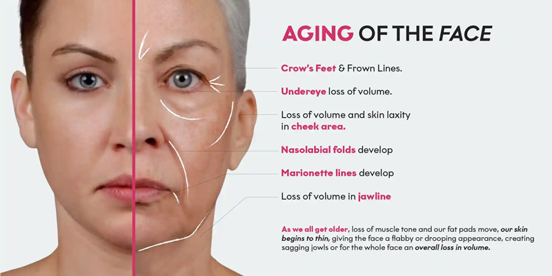 Aging of the face, need DV Facelift