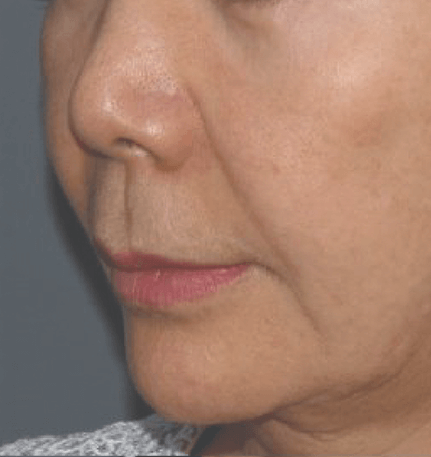 Patient 2 before Density treatment