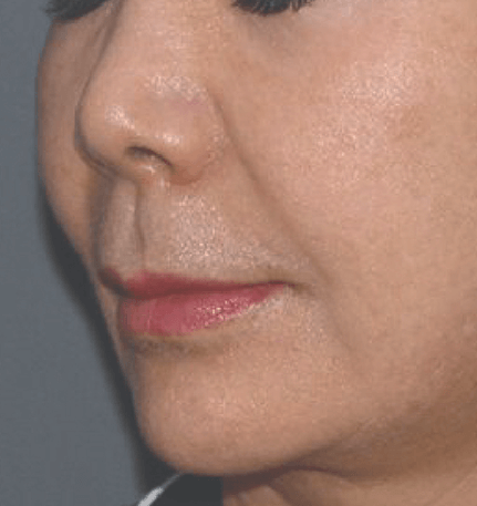 Patient 2 after Density treatment