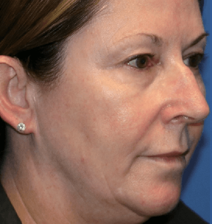 Patient 1 before Density treatment