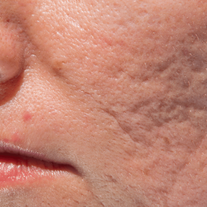 Feel your confidence return as Pico Laser shatters old scar tissue, paving the way for smoother, renewed skin.