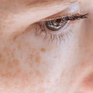 Liberate your complexion from dark spots—Pico Laser breaks down melanin clusters for an even, luminous glow.