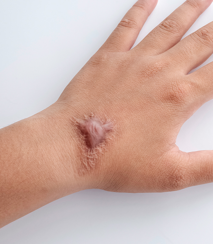 What Causes Keloids
