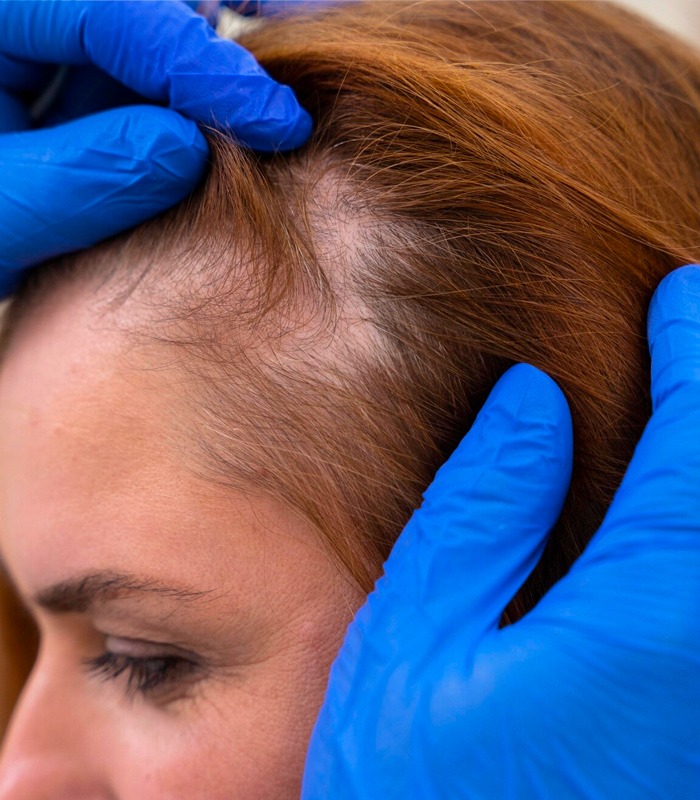 What Cause Hair Loss
