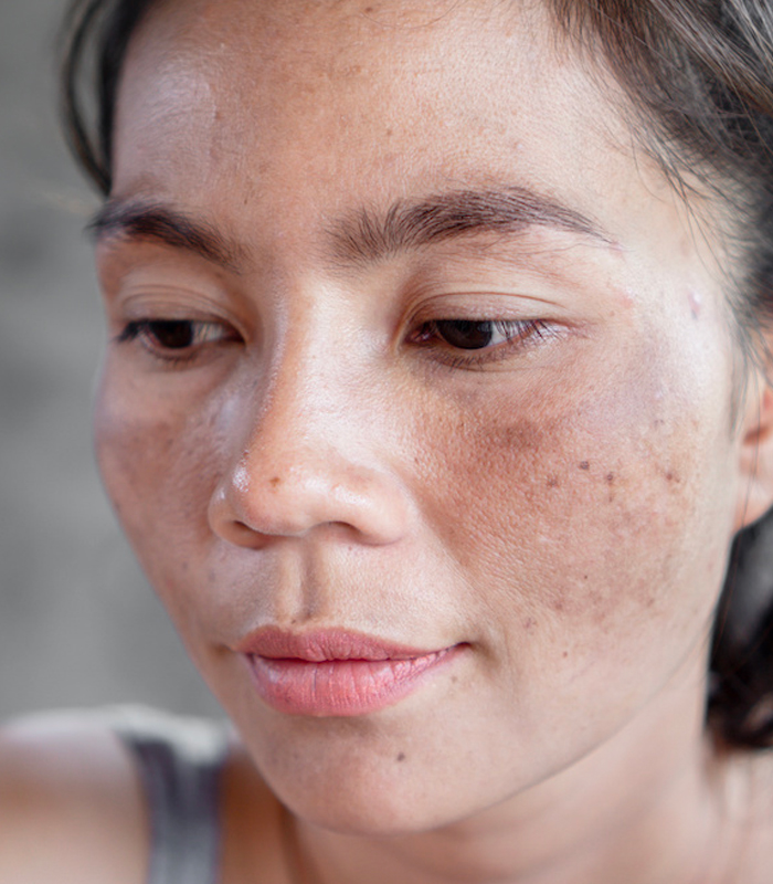 What Caused Melasma & Pigmentation