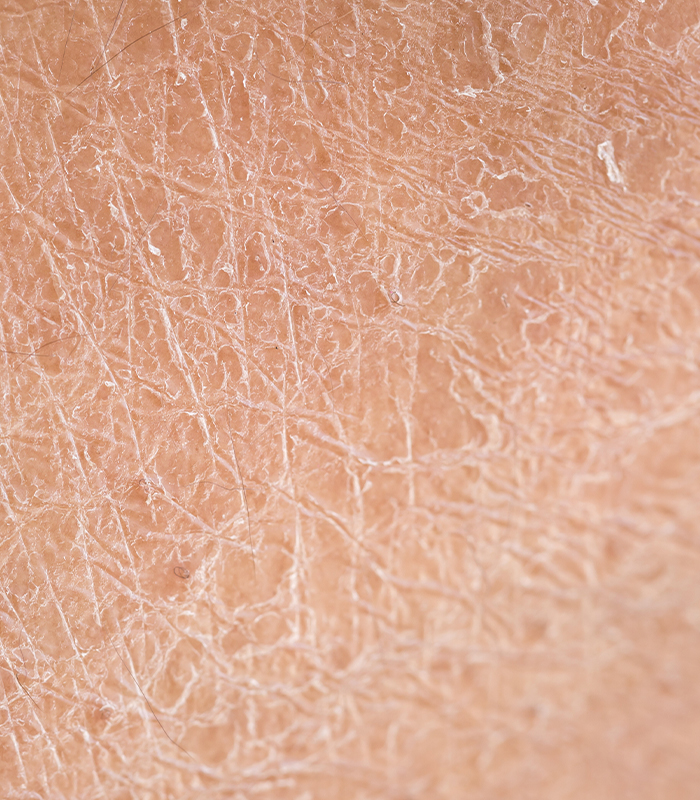 What Cause Rough and Dull Skin