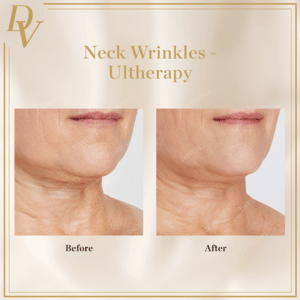 Neck Wrinkles Ultherapy Prime