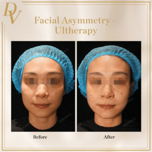 Ultherapy Prime