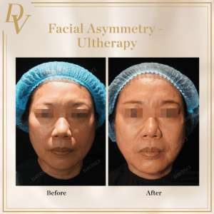 Facial Asymmetry & Saggy Ultherapy Prime Skin