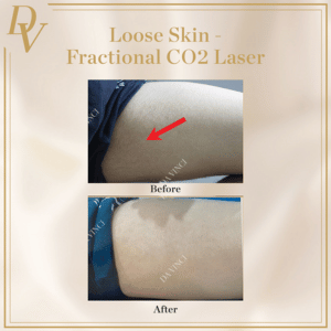 Fractional CO2 Laser