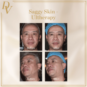 Ultherapy Prime Da Vinci Clinic