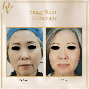 Saggy Skin Ultherapy Prime Before and After